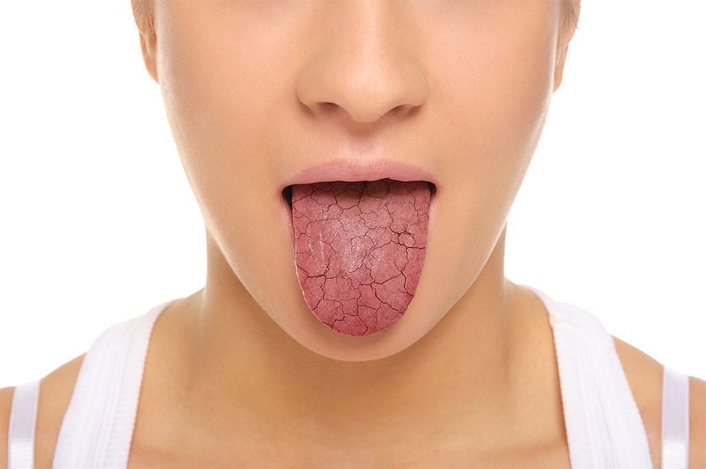 Xerostomia (Image via Getty Images)